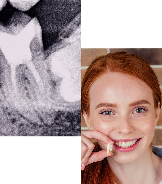 wisdom teeth